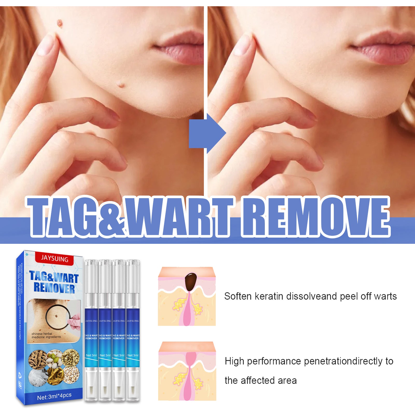Jaysuing Keyo Care Pen Body Face Flesh Grain Filamentary Skin Clean And Repair Smooth Skin
