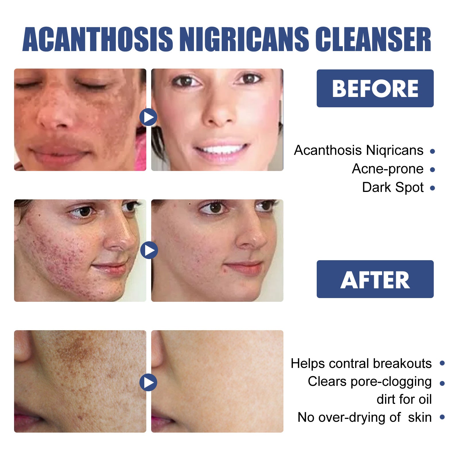 Black Acanthoderm Cleanser Face Deep Clean, Soft And Moisturizing Skin Repair Oil Control Cleansing Cleanser